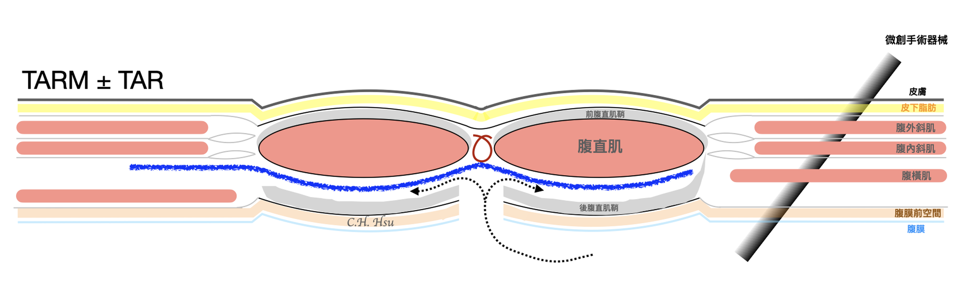 TARM 術式示意圖：網膜同樣置於肌肉後空間，但經由腹腔進入