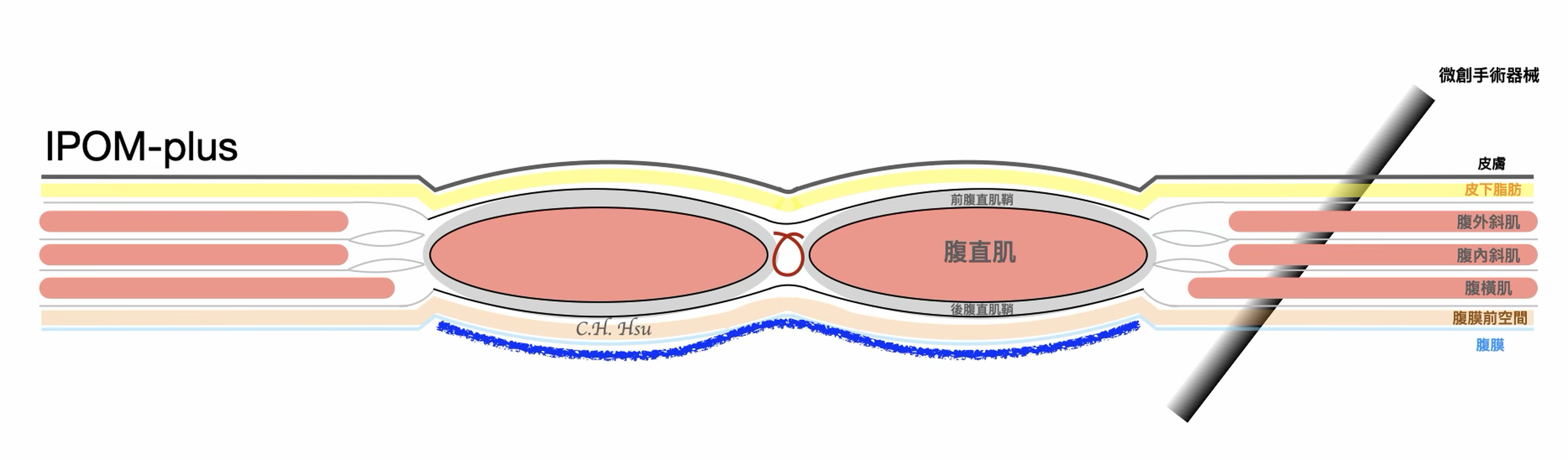 IPOM-plus 術式示意圖：縫合缺損後，將防沾黏網膜貼於腹腔內側