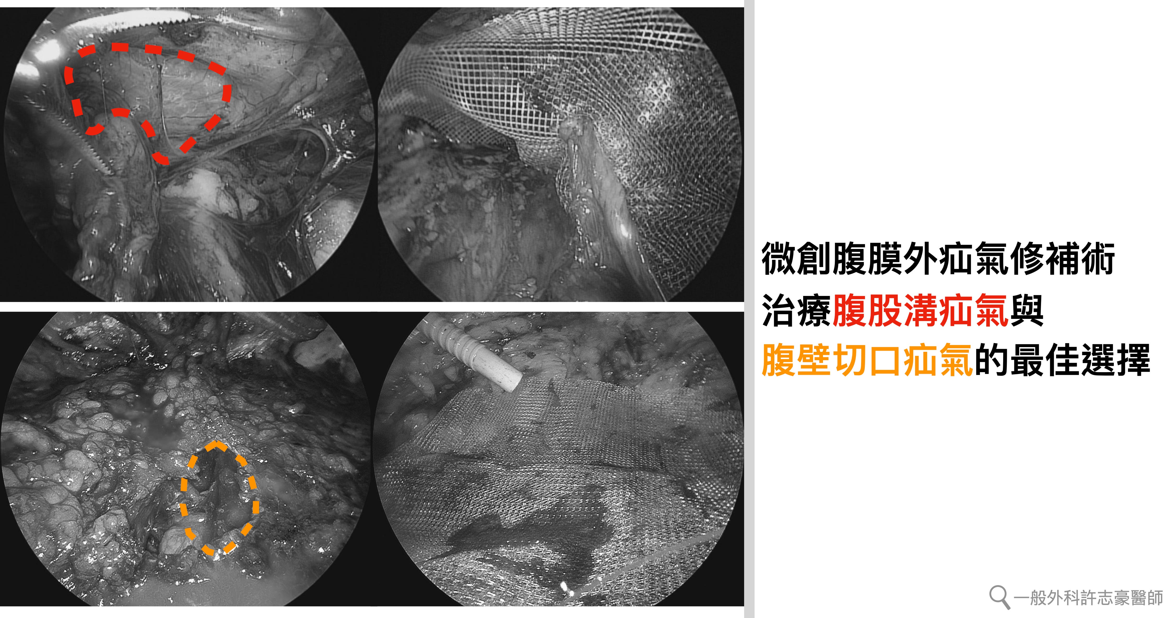 人工網膜放置位置與牛仔褲補丁原理示意圖