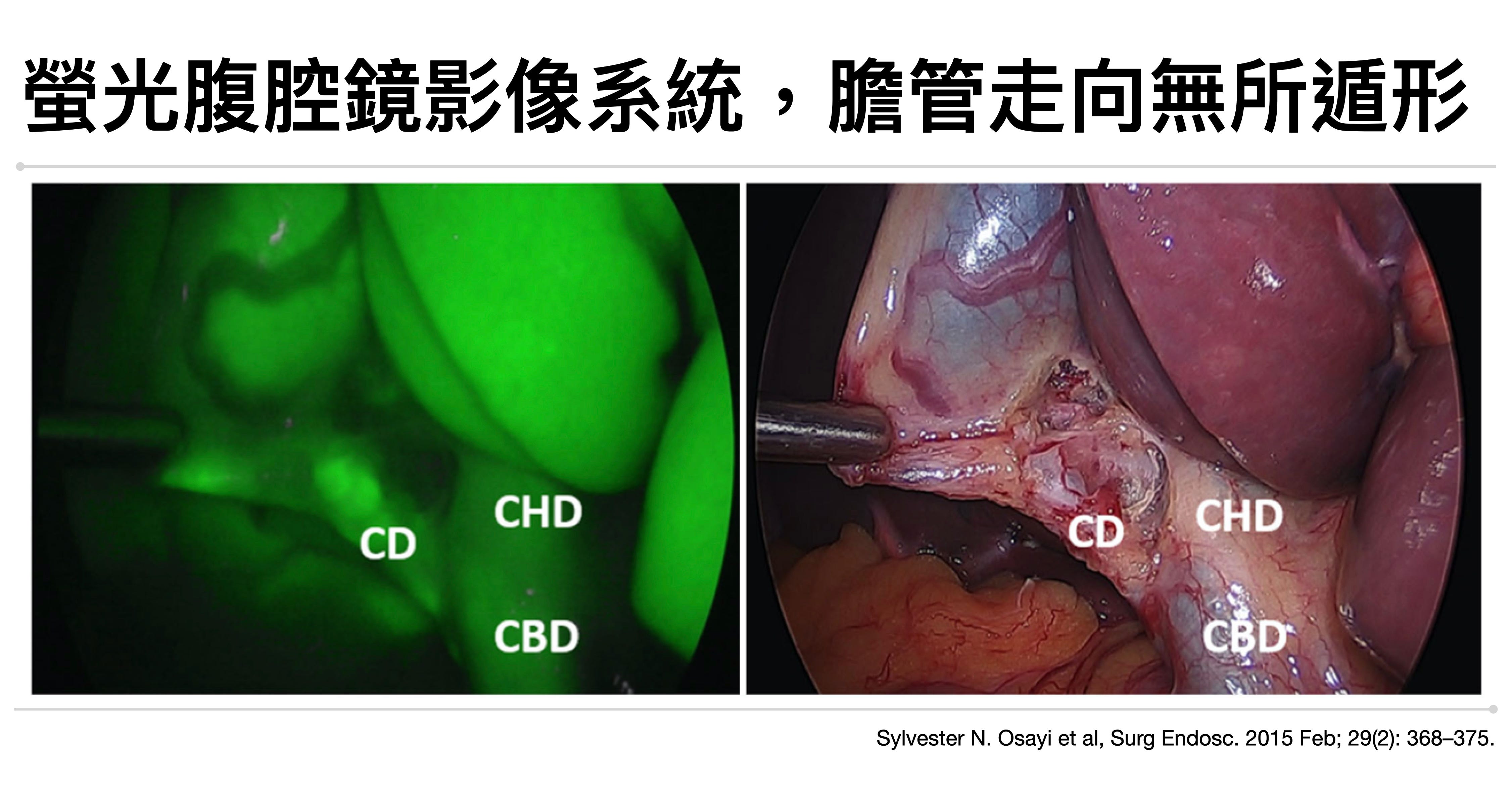 螢光腹腔鏡（ICG）影像