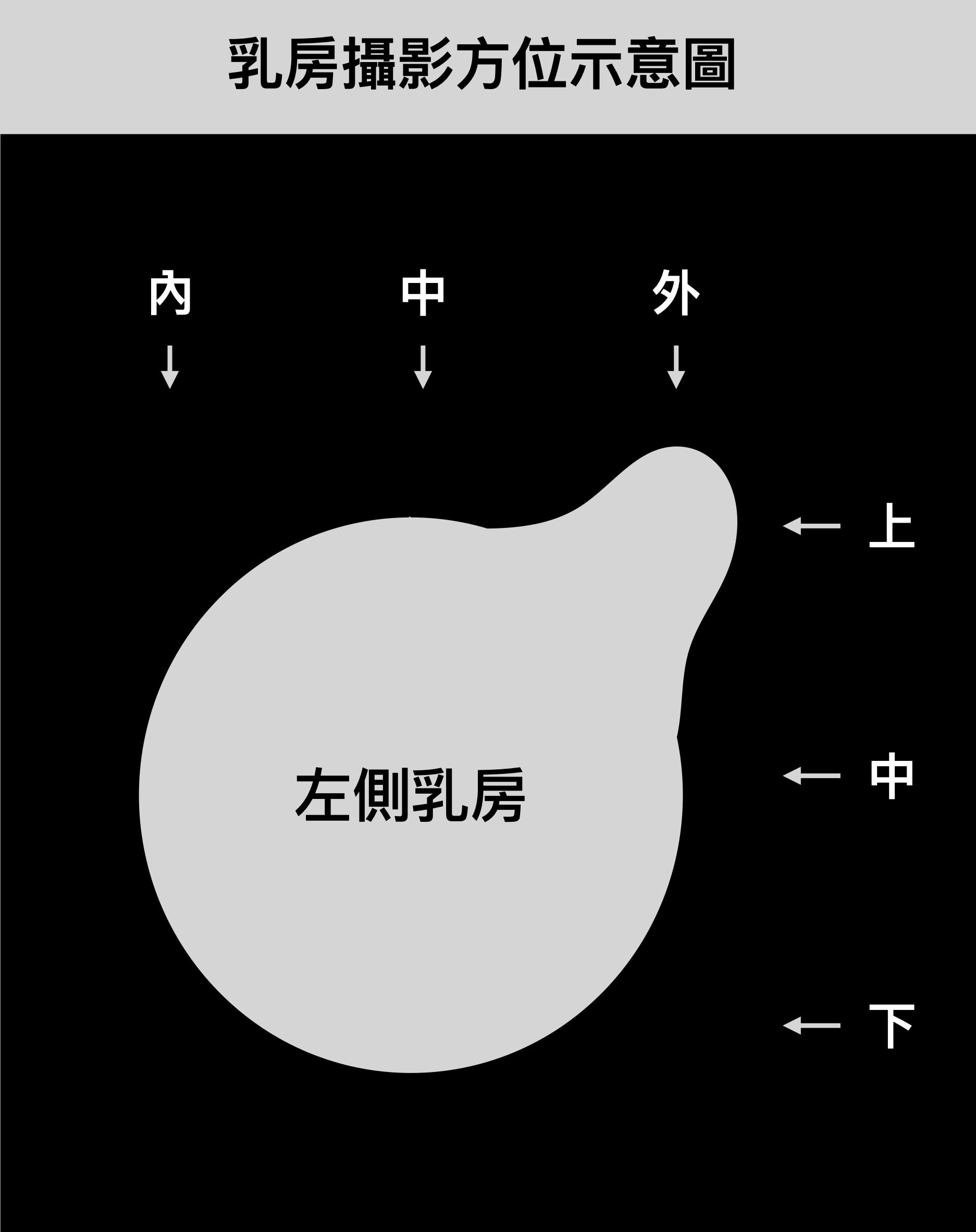 乳房攝影斜位向（MLO view）示意