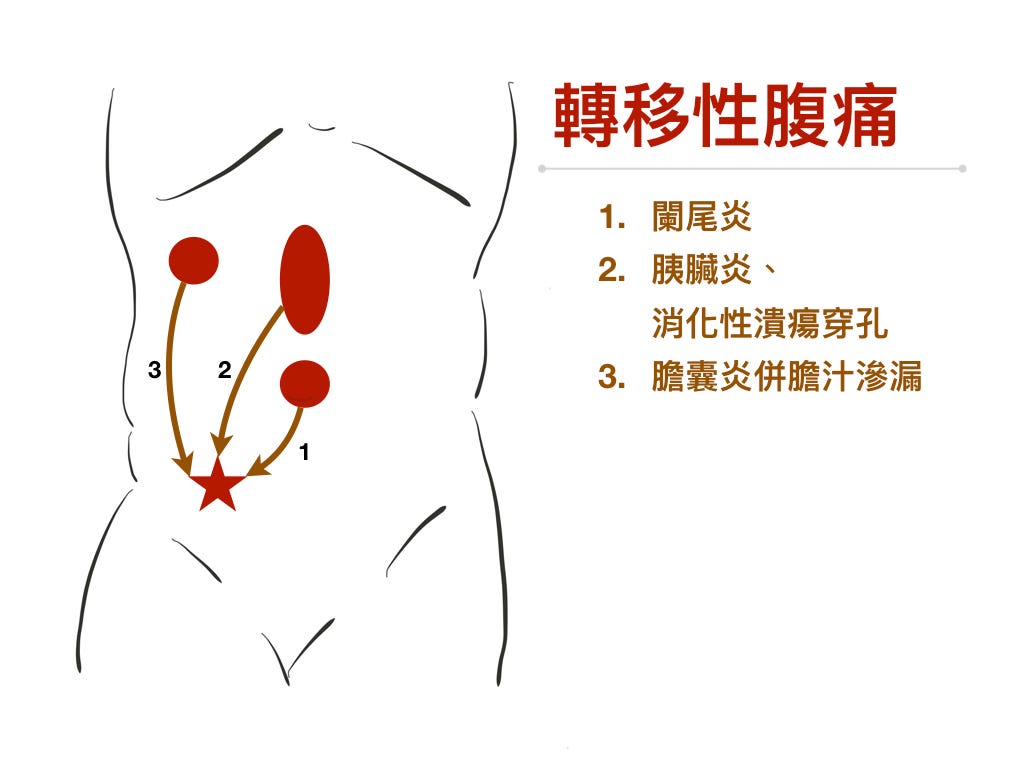 闌尾炎疼痛位置移轉示意圖