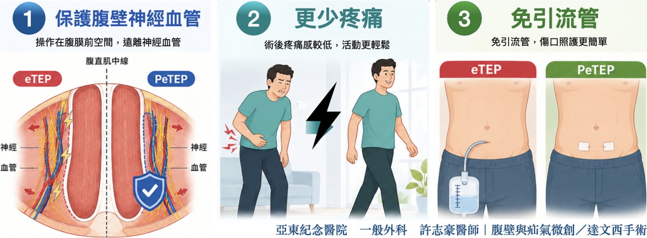 臍疝氣、腹直肌分離選用 PeTEP 三大優勢：保護腹壁神經血管、更少疼痛、免引流管